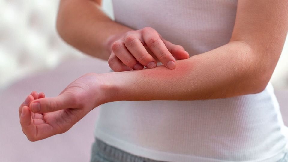 Vivir con Dermatitis Atópica